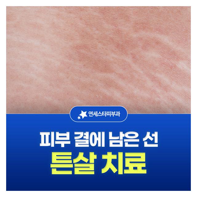 튼살 치료, 피부 곁에 남은 선 튼살 유형별 맞춤 치료 진행