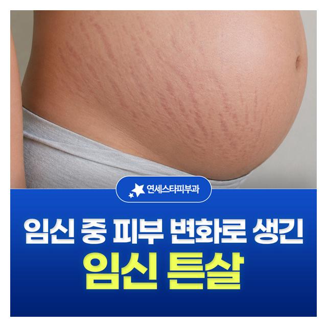 임신 튼살, 임신 중 피부 변화로 생긴 튼살 안전하고 통증 적은 튼살 치료