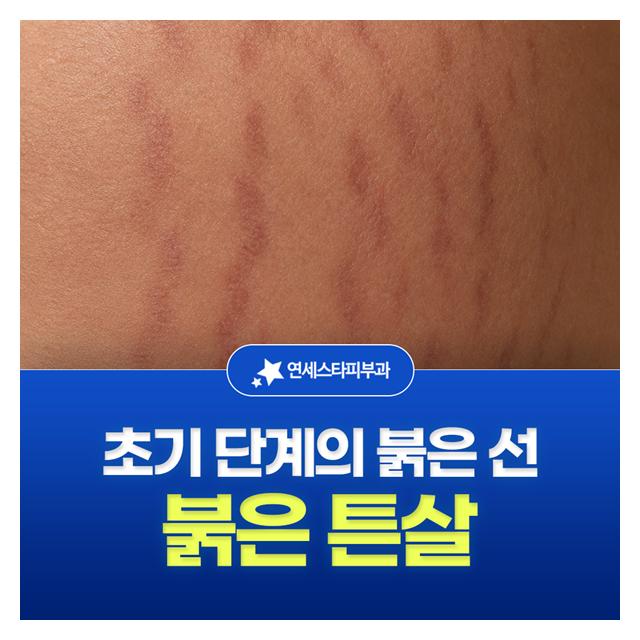 붉은 튼살, 초기 단계의 붉은 선 초기에 빠르게 잡아야 합니다