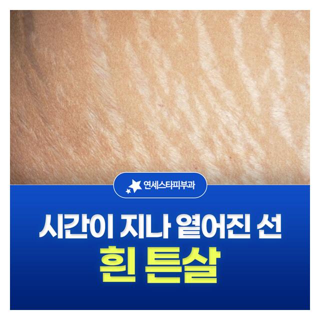 흰 튼살, 시간이 지나 옅어진 선 유형별 맞춤치료로