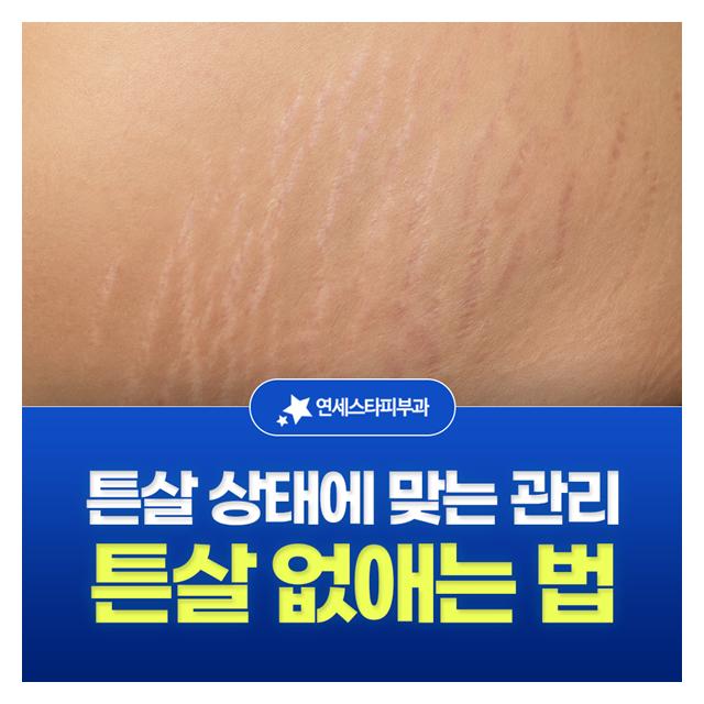 튼살 없애는 법, 튼살 상태에 맞는 관리와 체계적인 치료로