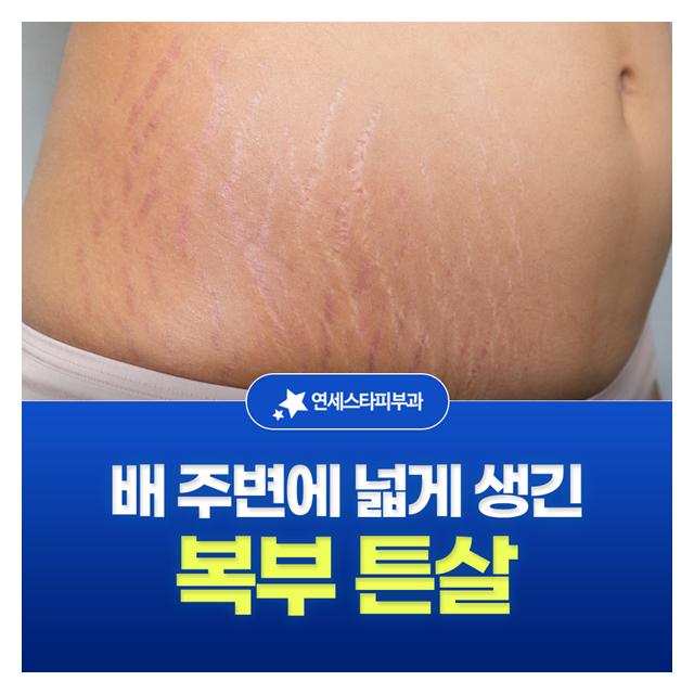 복부 튼살, 배 주변에 넓게 생긴 선 색소침착 걱정 없는 튼살 치료